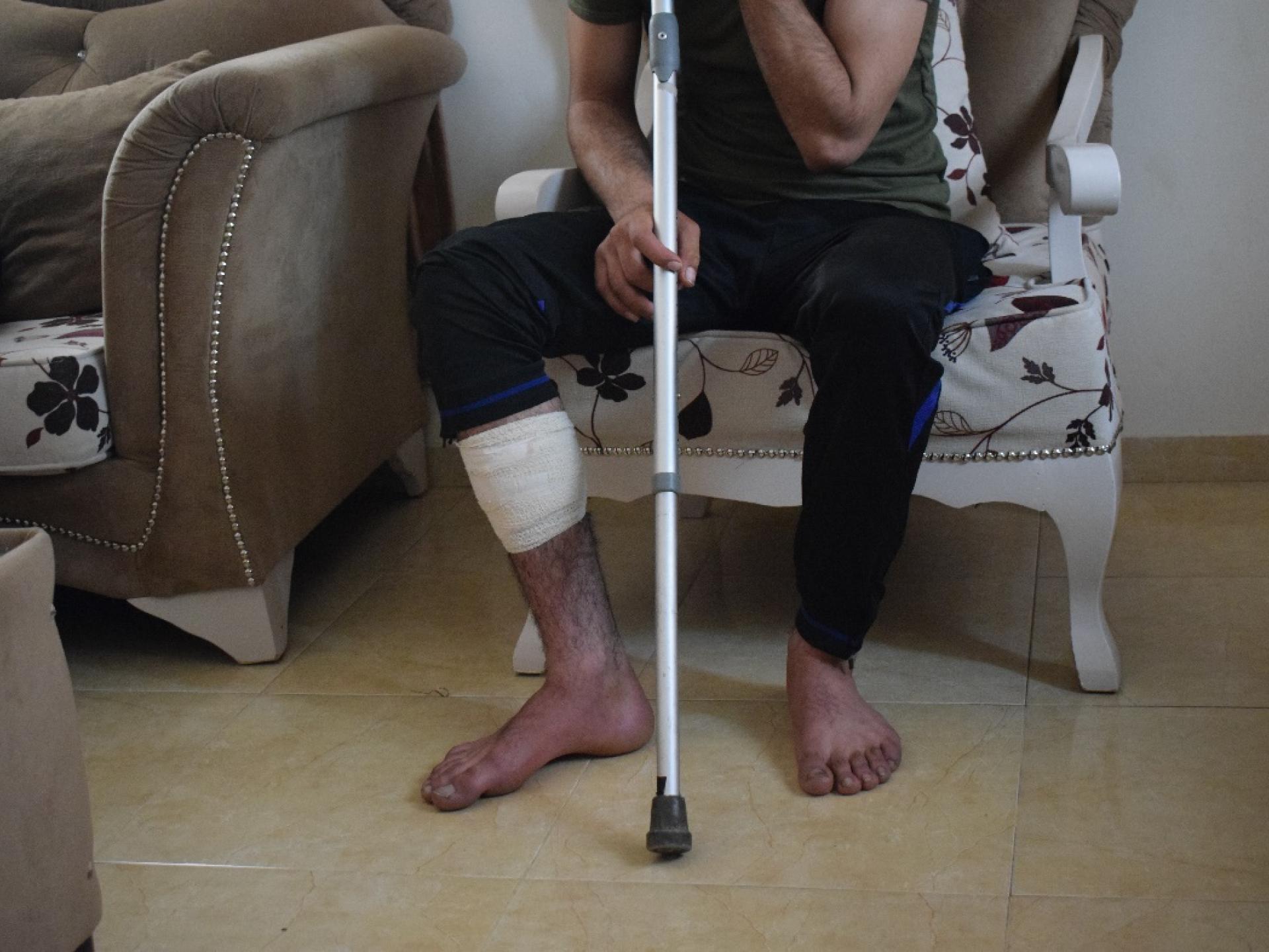  The bandaged leg of the young man from Yitzhar who settlers beat with an iron bar after he prevented them from cutting the olive trees.