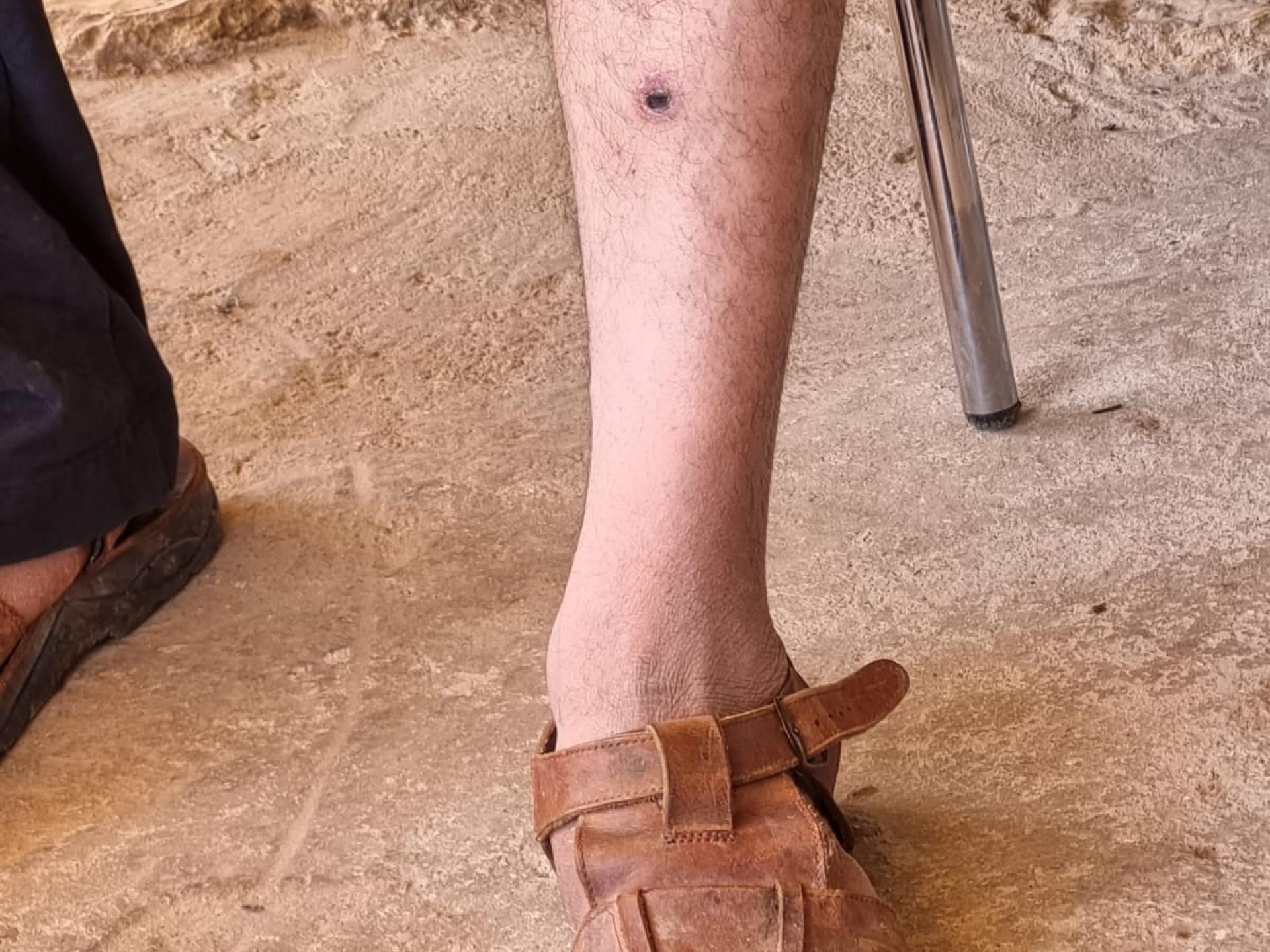 שעב אל בוטום - רגלו החבולה של מוחמד ג'בארין אחרי כ-20 יום ועדיין סובל מכאבים