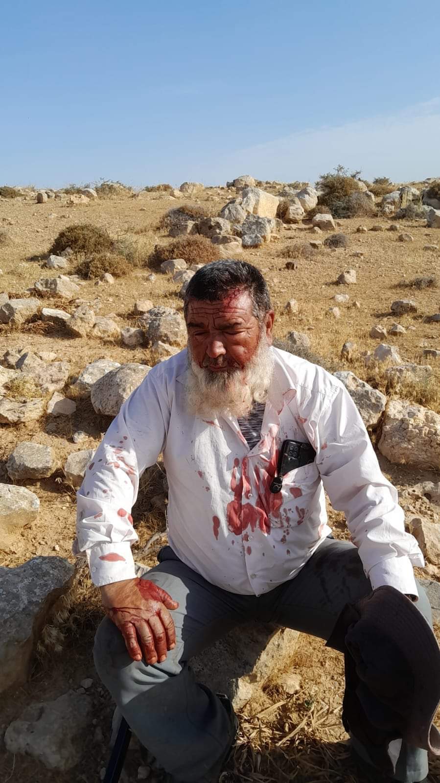 Mufaqara - Naim Hamamada who was injured by a settler attack two days before we arrived